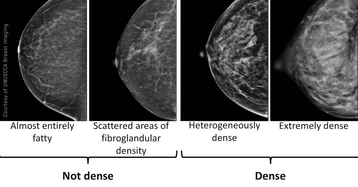 What's the best way to screen dense breasts?