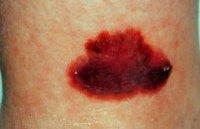 melanotic sarcoma begins with metastatic Clear Cell Sarcoma of Soft Tissues: Radiological Analysis of 14 PatientsMRI Findings Melanoma vs. Sarcoma: Identifying the