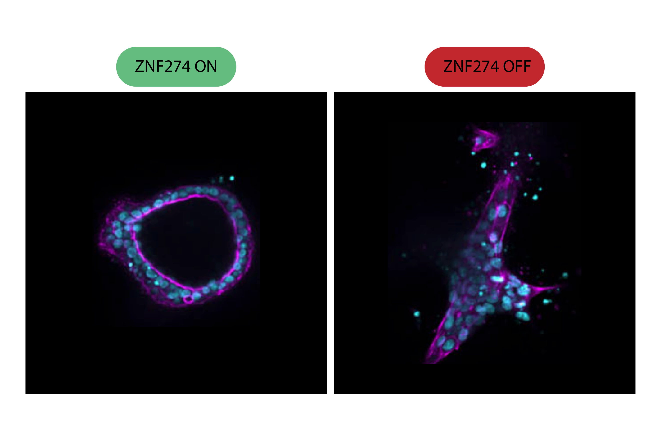 Reprogramming pancreatic cancer to become more treatment