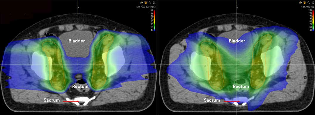 How Long Is Proton Therapy For Prostate Cancer