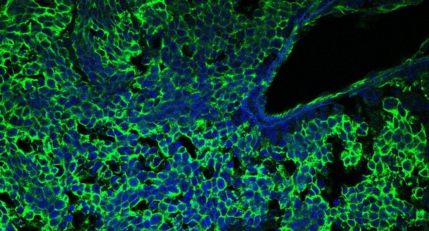 New insights into drug resistance in small cell lung cancer - Fred Hutch