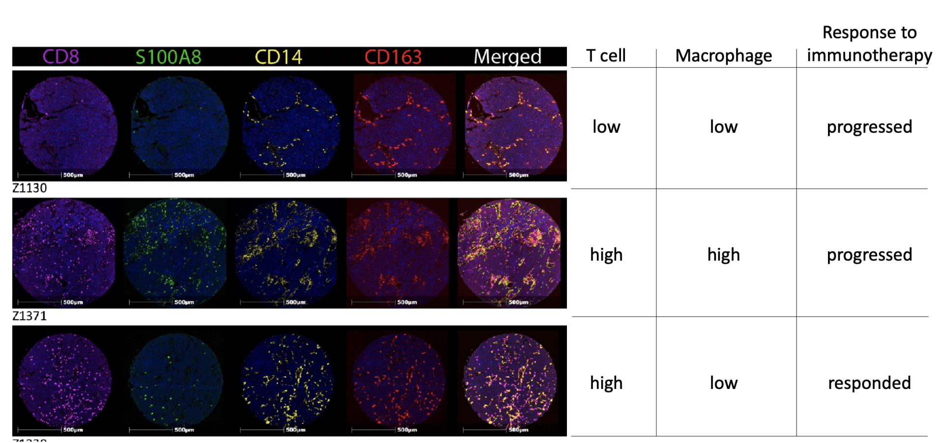 Macrophages predict response to immunotherapy in Merkel cell